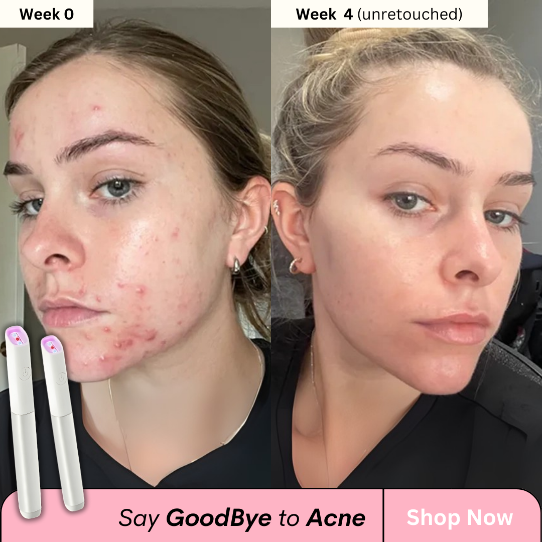 Acne-Vanish Pro™