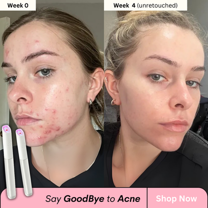 Acne-Vanish Pro™