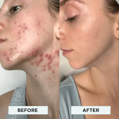 Acne-Vanish Pro™